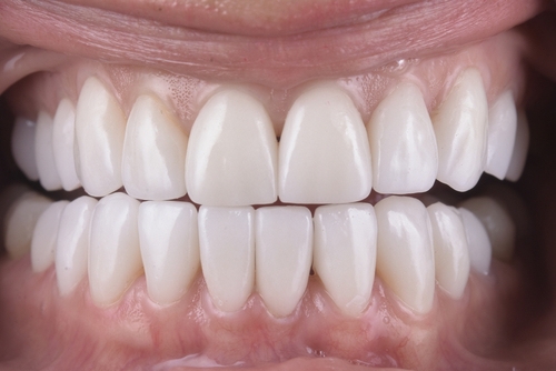 Dental Crown Lengthening in Wayne, NJ | Fine Dental Care