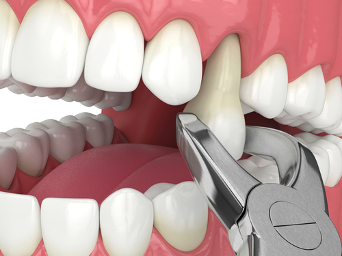 Extracciones Dentales en Wayne, NJ | Dr. Fine | Fine Dental Care