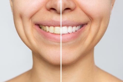 Blanqueamiento dental en Wayne, NJ | Dr. Bruce Fine | Fine Dental Care