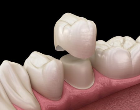 Dental Crowns in Wayne NJ Dr. Bruce Fine Fine Dental Care 2