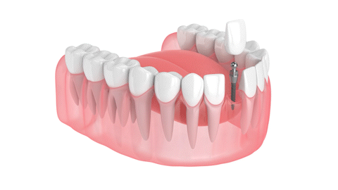 Mini Dental Implants in Wayne NJ Fine Dental Care