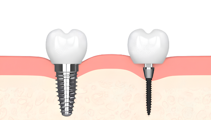 New Teeth in Wayne, NJ Mini Implants Book a Free Consultation!