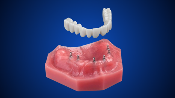 Alternativas a la dentadura postiza en el condado de Essex | ¡Consulte gratis!
