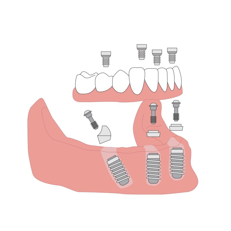 All-on-4 Alternatives in Wayne, NJ | Free Implant Consultations!