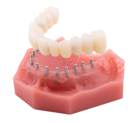 Implant Supported Bridge in Wayne, NJ | Non-Removable Roundhouse Bridge