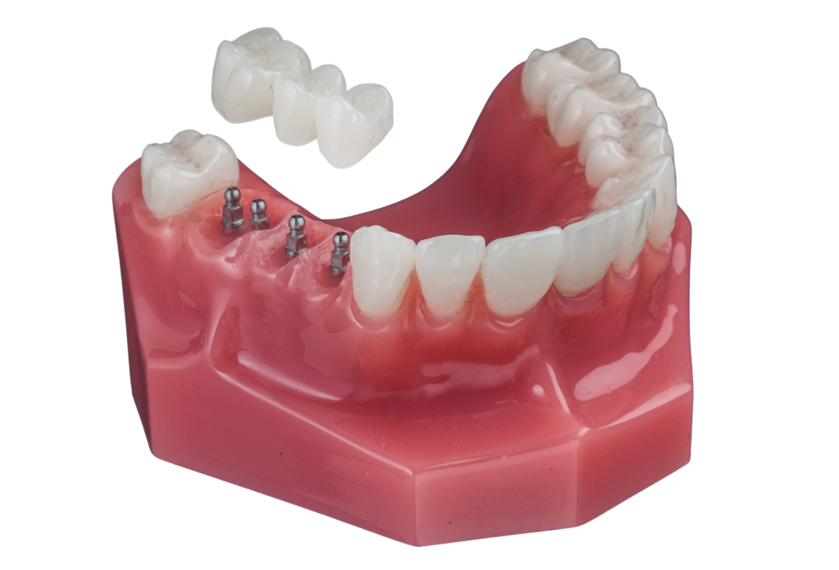 Dental Implants in Warren, NJ | Book a Free Consultation Today!