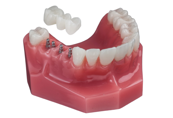 Dental Implants in Warren, NJ | Book a Free Consultation Today!