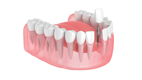 Mini Implants Cost in Wayne, NJ | Restore Your Smile Affordably
