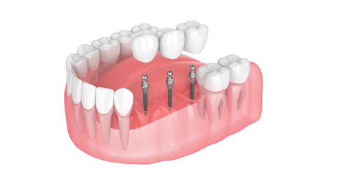 Same Day Extraction and Implant in Wayne, NJ | Mini Dental Implant Placement