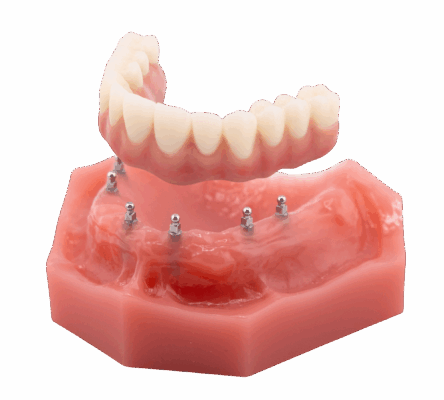 Full Mouth Mini Dental Implants in Wayne, NJ | Free Consultations