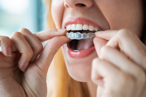 Braces Alternatives in Wayne NJ | Straighten Your Smile Comfortably