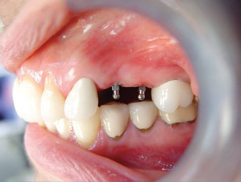 Mini Implant in Wayne, NJ | Book a Free Consultation With Dr. Fine!