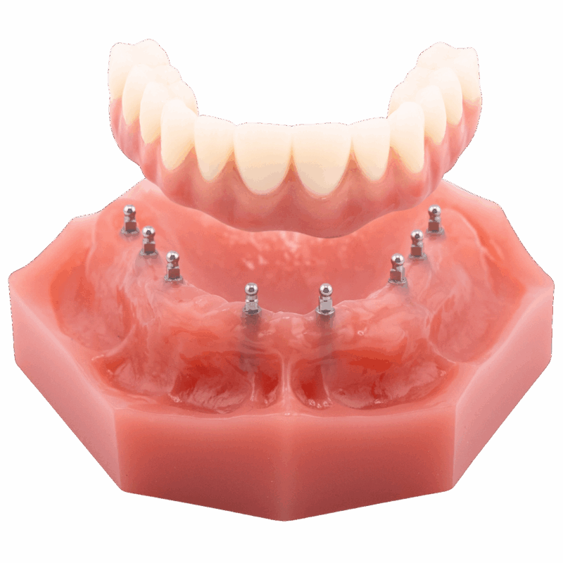 What Is the Process for Implant Dentures? | Free Implant Consultation in Wayne, NJ