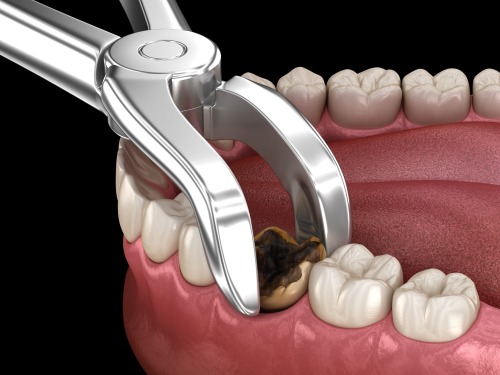 Extractions in Wayne NJ | Gentle Dental Care Near Me | Dr. FIne