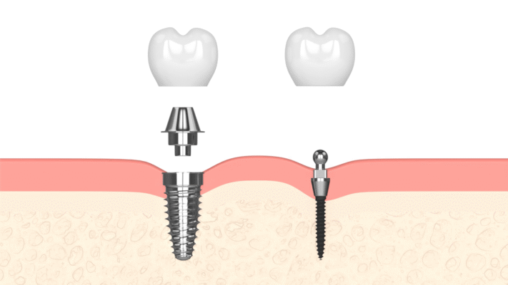 Mini Implants vs. Regular Implants in Wayne, NJ | Free Consults 🦷