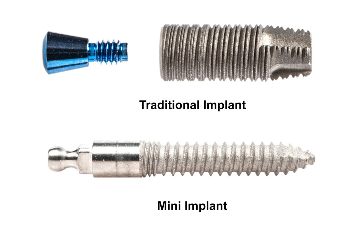 Best Implant Options in 2026 [A Video Guide] | Free Consultations