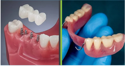 Implant Bridge [Watch Before You Decide] Free Implant Consults