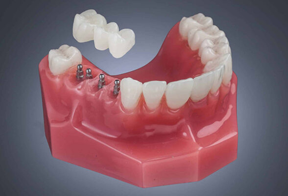 Implant Bridge [Watch Before You Decide] | Implant Bridge in Wayne, NJ