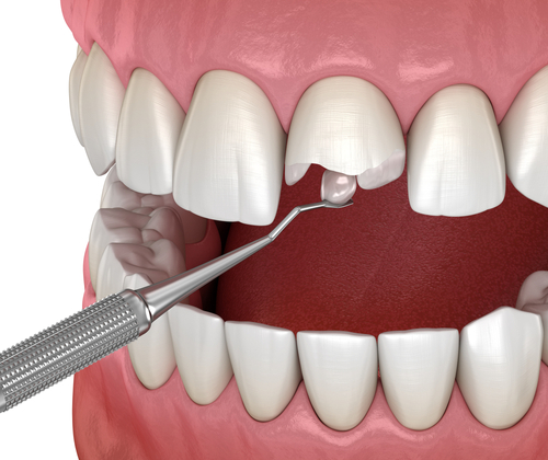 Broken Tooth [See Real Before & After Results] Emergency Dentist