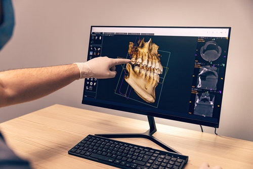 Missing Teeth in Wayne NJ | Book Your Free Implant Consultation!