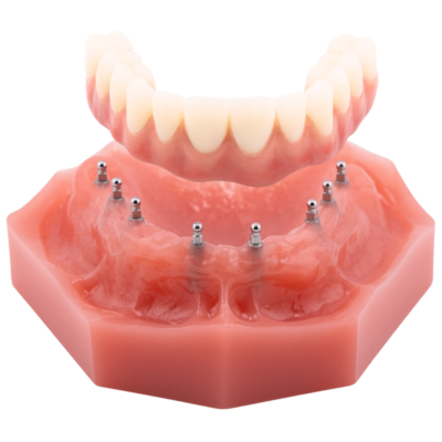 Full Mouth Dental Implants in Wayne, NJ | Semi-Removable Roundhouse Bridges