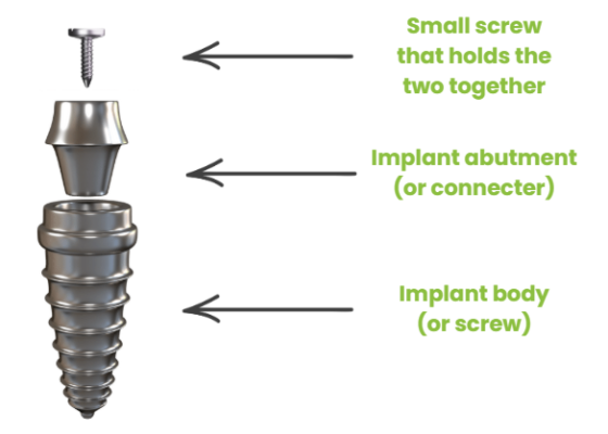 One-Piece Implants in Wayne, NJ vs. Multi-Piece Implants