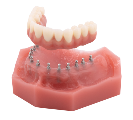 Denture Alternatives in Wayne, NJ | Anchor Your Denture In Place With Mini Dental Implants