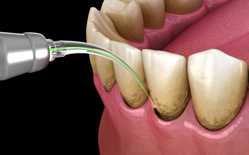 Laser Gum Disease Treatment in Wayne, NJ [Video Inside]