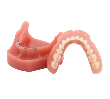 Traditional Denture Alternatives in Wayne, NJ | Book a Free Implant Consultation