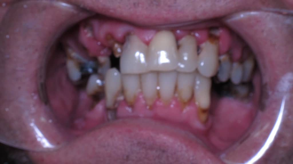 Full Mouth Reconstruction Before