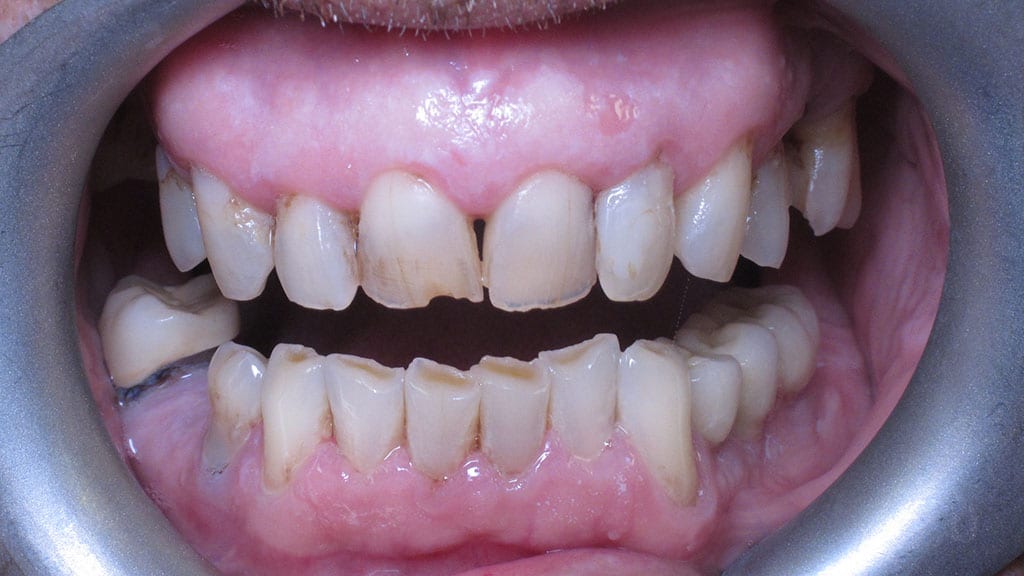 Teeth Before