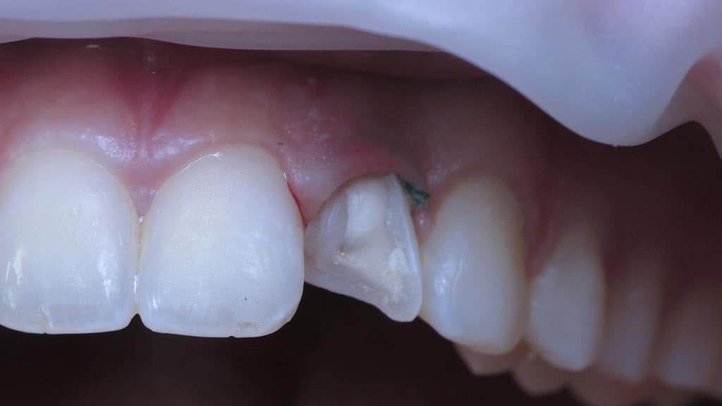 Broken Tooth Before