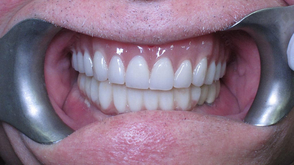 Denture and Implants After