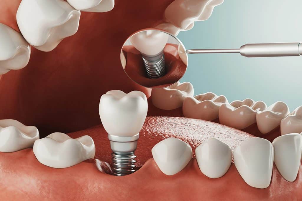 How Do Dental Implants