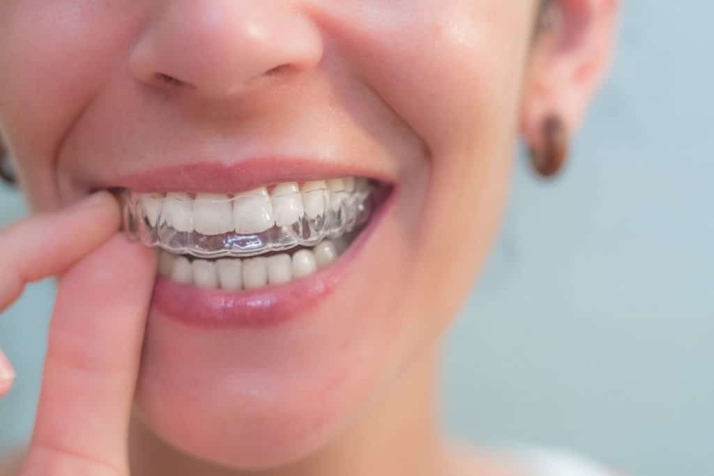 How Long Does Invisalign