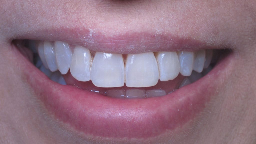 Invisalign Case After